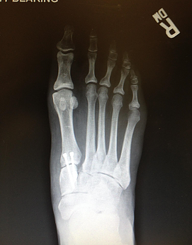 Revisional base bunion correction from another doctor. Corrected with bone graft, screws and k-wires since removed.
