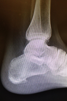 Retrocalcaneal exostosis and pump bump resection.