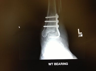 Tibial, fibular, and talar bone cyst treated with bone graft and pediatric blade plate and screws.